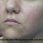 PRP (platelet-rich plasma) / PRF (platelet rich fibrin) Before & After Patient #875