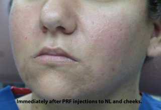PRP (platelet-rich plasma) / PRF (platelet rich fibrin) Before & After Patient #875