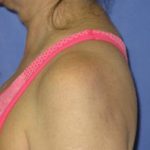 VASER Liposuction Before & After Patient #1436