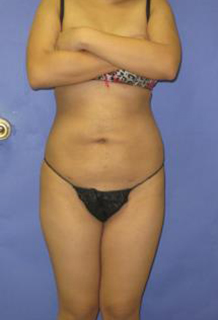 VASER Liposuction Before & After Patient #1447