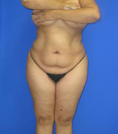 VASER Liposuction Before & After Patient #1450