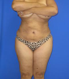 VASER Liposuction Before & After Patient #1450