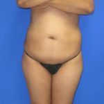 VASER Liposuction Before & After Patient #7250