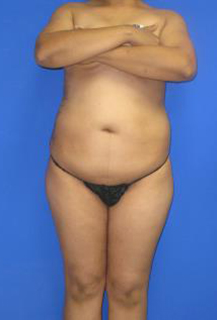 VASER Liposuction Before & After Patient #7250