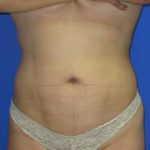 VASER Liposuction Before & After Patient #1457