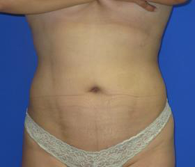 VASER Liposuction Before & After Patient #1457