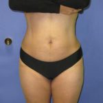 VASER Liposuction Before & After Patient #1460