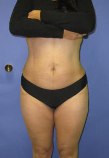 VASER Liposuction Before & After Patient #1460