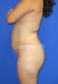 VASER Liposuction Before & After Patient #1460