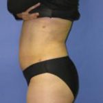 VASER Liposuction Before & After Patient #1460