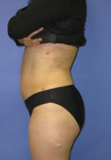 VASER Liposuction Before & After Patient #1460