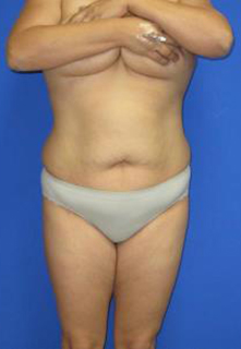 VASER Liposuction Before & After Patient #1465