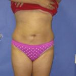 VASER Liposuction Before & After Patient #1465