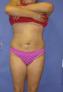 VASER Liposuction Before & After Patient #1465