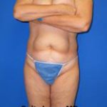 VASER Liposuction Before & After Patient #1470
