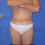 VASER Liposuction Before & After Patient #1470