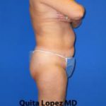 VASER Liposuction Before & After Patient #1470