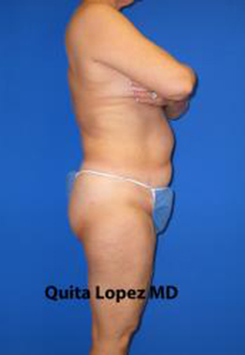 VASER Liposuction Before & After Patient #1470