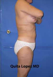 VASER Liposuction Before & After Patient #1470