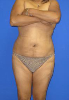 VASER Liposuction Before & After Patient #1475
