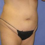 VASER Liposuction Before & After Patient #1481