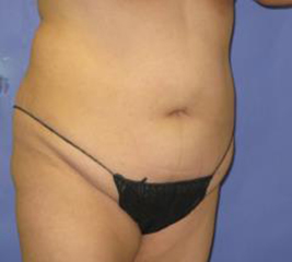 VASER Liposuction Before & After Patient #1481