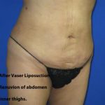 VASER Liposuction Before & After Patient #1481