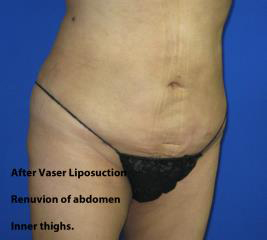 VASER Liposuction Before & After Patient #1481