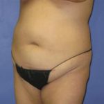 VASER Liposuction Before & After Patient #1481