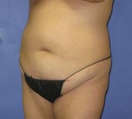 VASER Liposuction Before & After Patient #1481