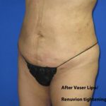 VASER Liposuction Before & After Patient #1481