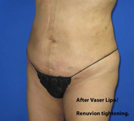 VASER Liposuction Before & After Patient #1481