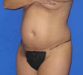 VASER Liposuction Hi-Def Before & After Patient #1486
