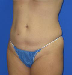 VASER Liposuction Hi-Def Before & After Patient #1489