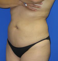 VASER Liposuction Before & After Patient #7125