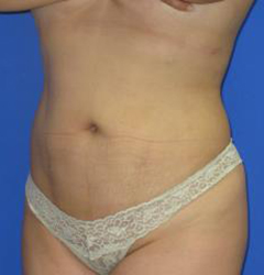 VASER Liposuction Before & After Patient #7125