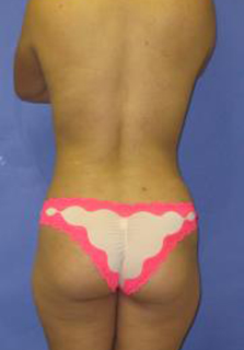 VASER Liposuction Before & After Patient #7128