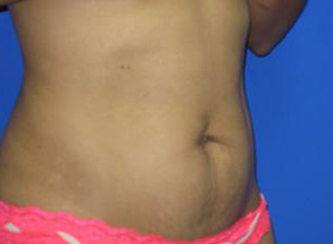 VASER Liposuction Before & After Patient #7128