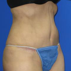 VASER Liposuction Hi-Def Before & After Patient #7133
