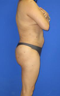 VASER Liposuction Before & After Patient #7136