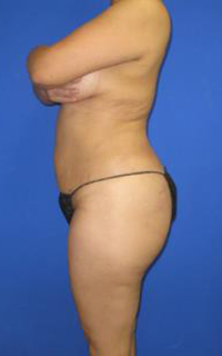 VASER Liposuction Before & After Patient #7139
