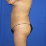 VASER Liposuction Before & After Patient #7142