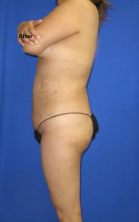 VASER Liposuction Before & After Patient #7142