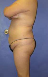 VASER Liposuction Before & After Patient #7142