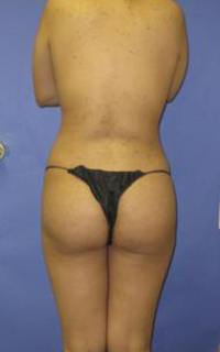 VASER Liposuction Before & After Patient #7148
