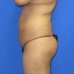 VASER Liposuction Before & After Patient #7153
