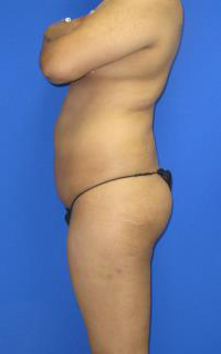 VASER Liposuction Before & After Patient #7153