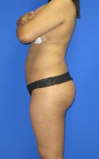 VASER Liposuction Before & After Patient #7153