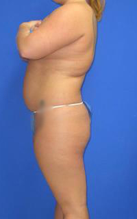 VASER Liposuction Before & After Patient #7156