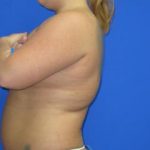 VASER Liposuction Before & After Patient #7156